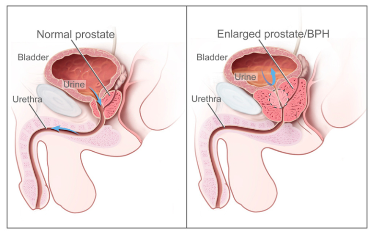 Swollen Prostate